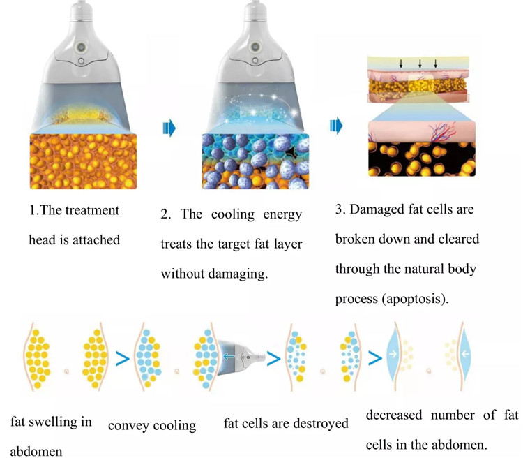 Cryolipolysis and EMSculpt Combined Machine