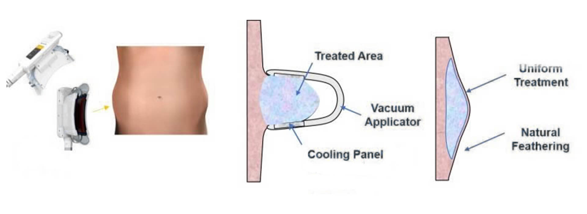 3 in 1 Cooling Body Contouring Machine