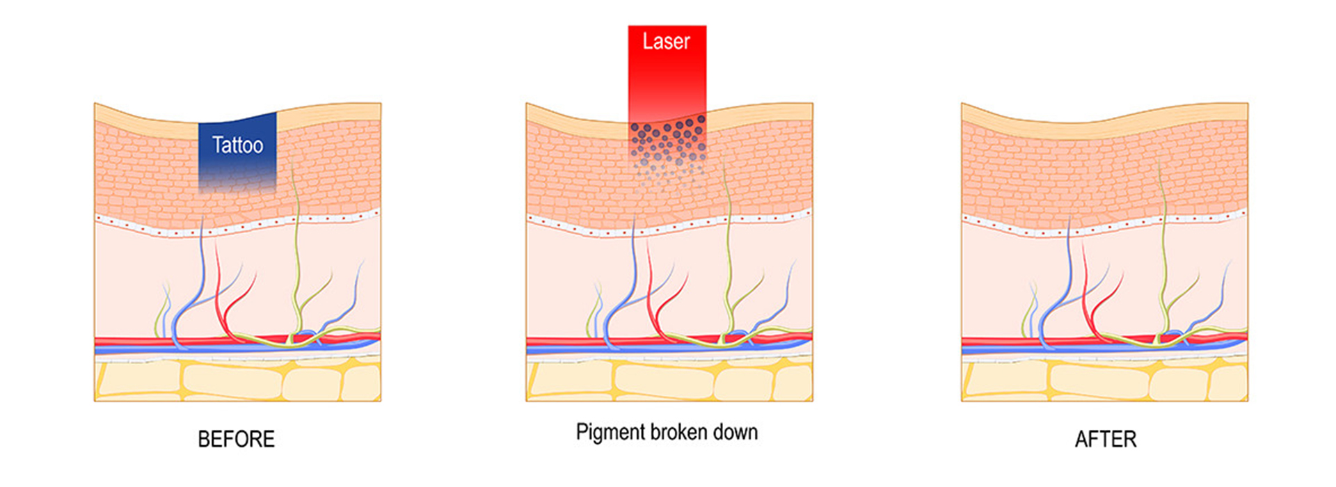 Q-Switched ND YAG Laser Machine