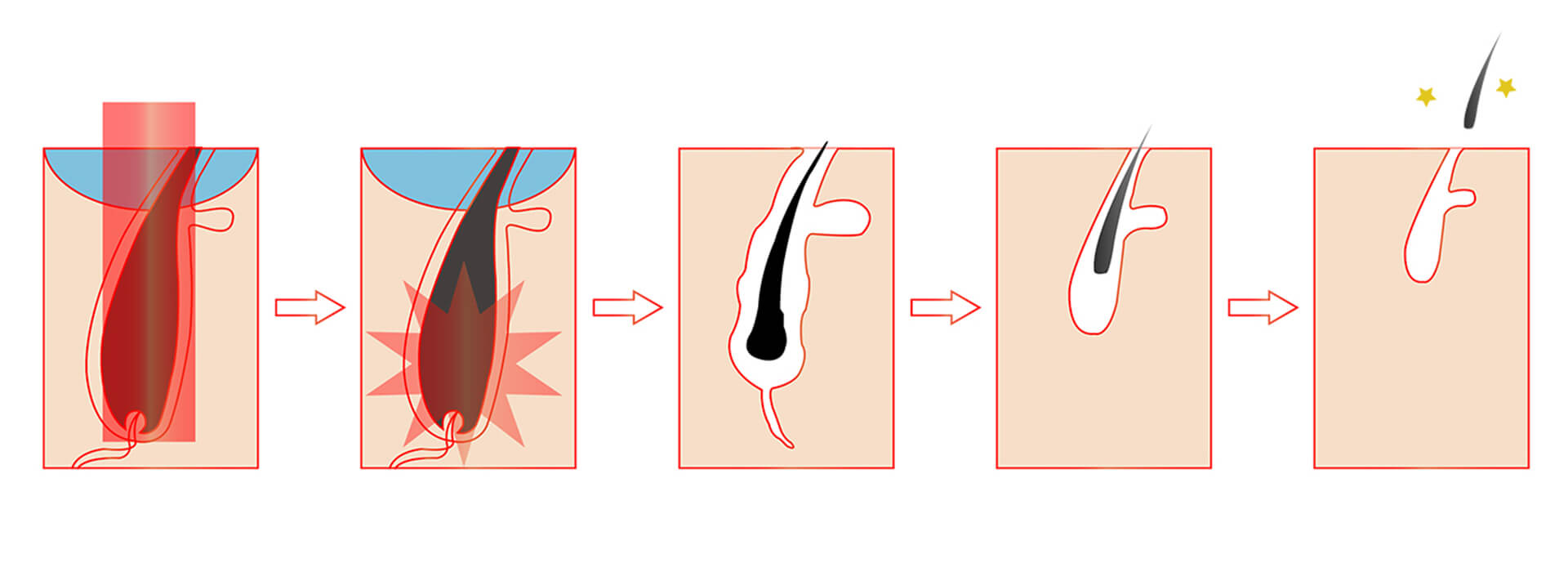 RAZORLASE® 3 in 1 Hair Removal Machine