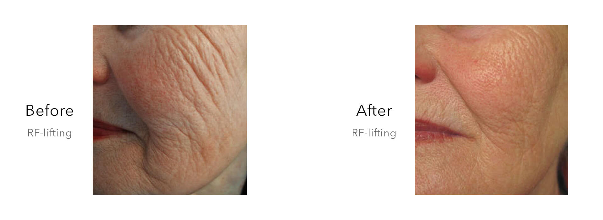 RF Microneedling