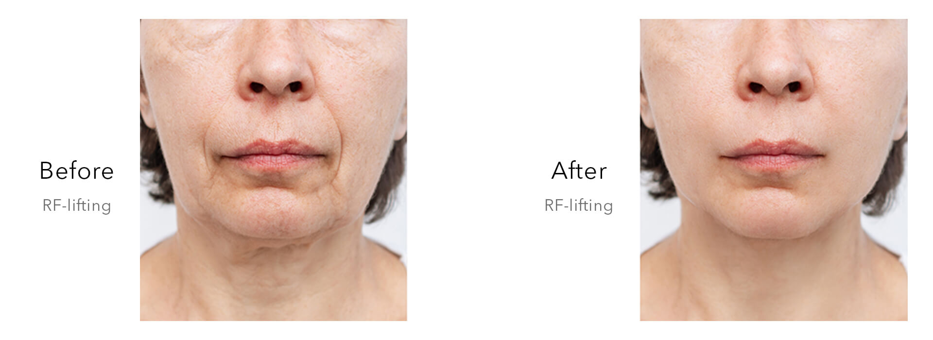 RF Microneedling