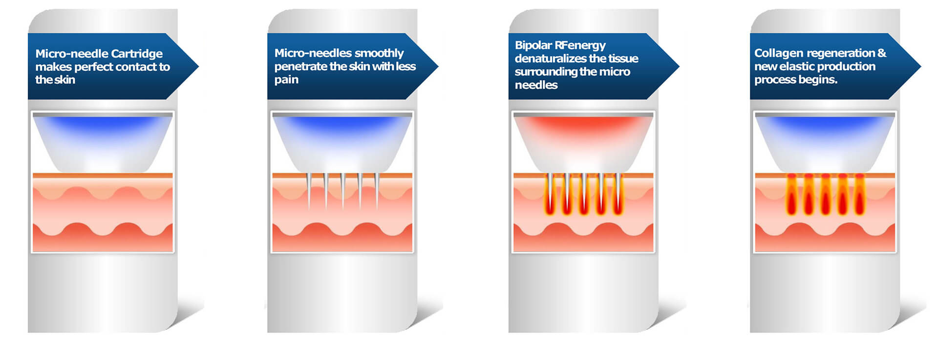 RF Microneedling