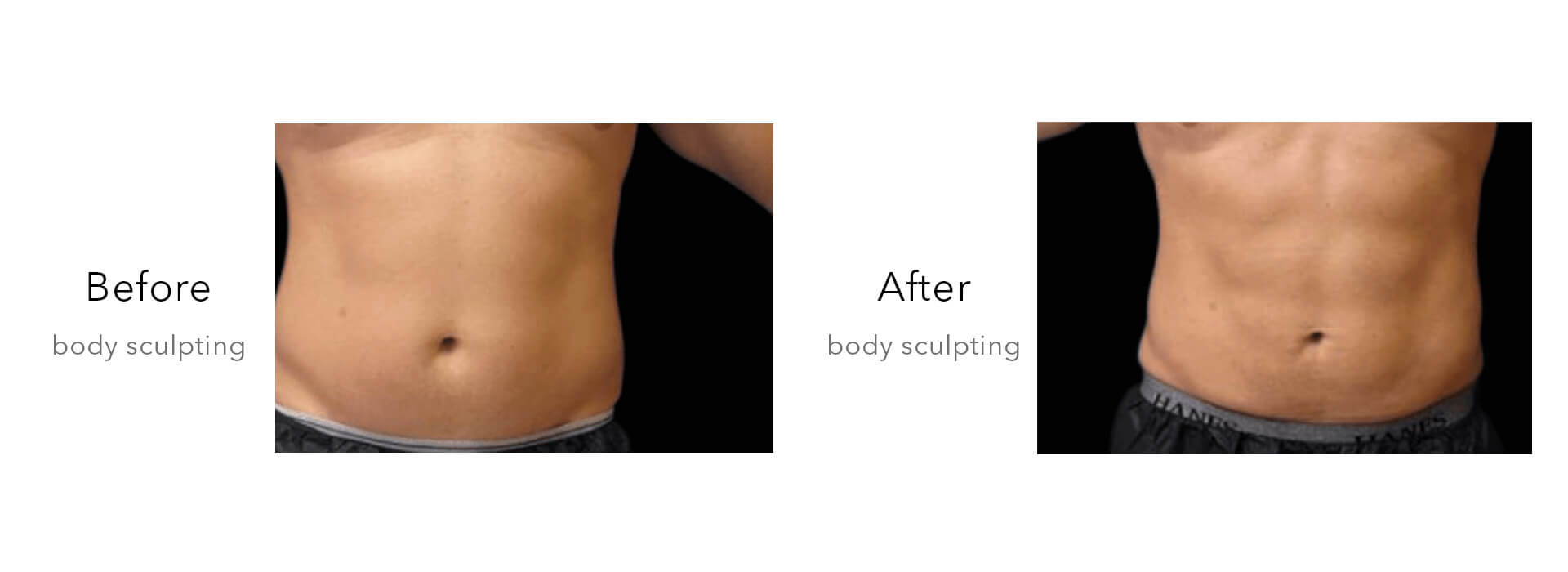 Cryolipolysis and EMSculpt Combined Machine