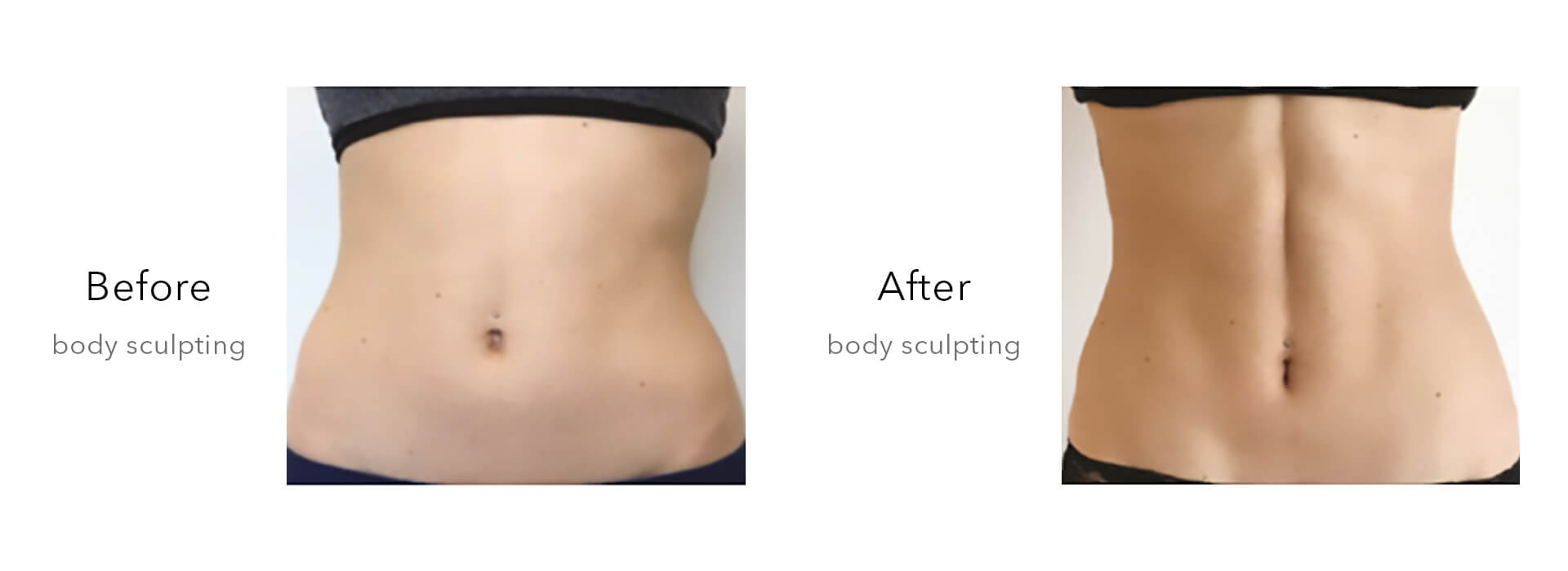 Cryolipolysis and EMSculpt Combined Machine