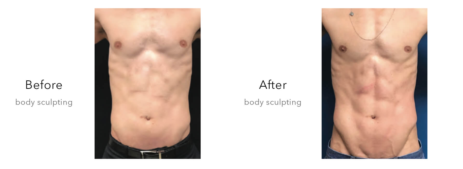 Cryolipolysis and EMSculpt Combined Machine